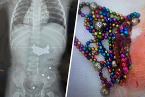 Boy ate magnets in Dagestan: doctors in intensive care are fighting for his life